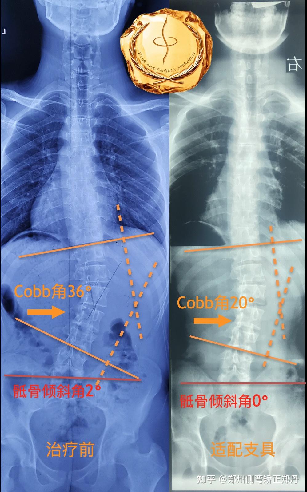 后凸cobb角图片