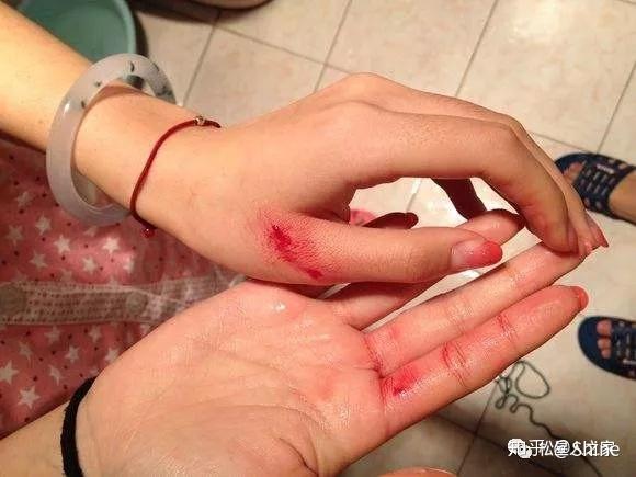 被松鼠咬伤怎么办