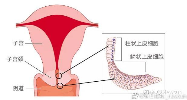 上週我的留言裡還有一位網友說,幾年前,因為宮頸糜爛早就做了錐切.