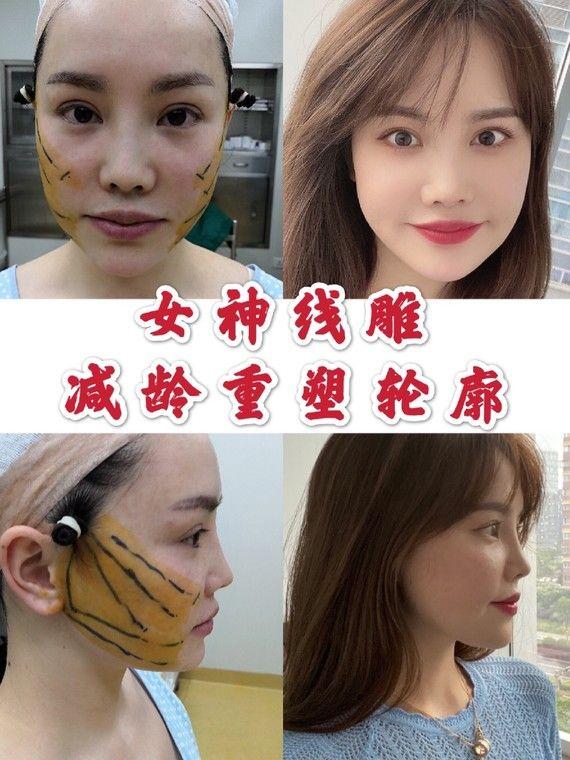 案例分享线雕pk引力大作战拯救妹子年龄危机