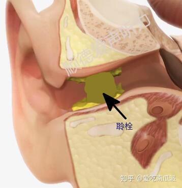 耳鸣与耵聆 耳屎 有什么关系 知乎