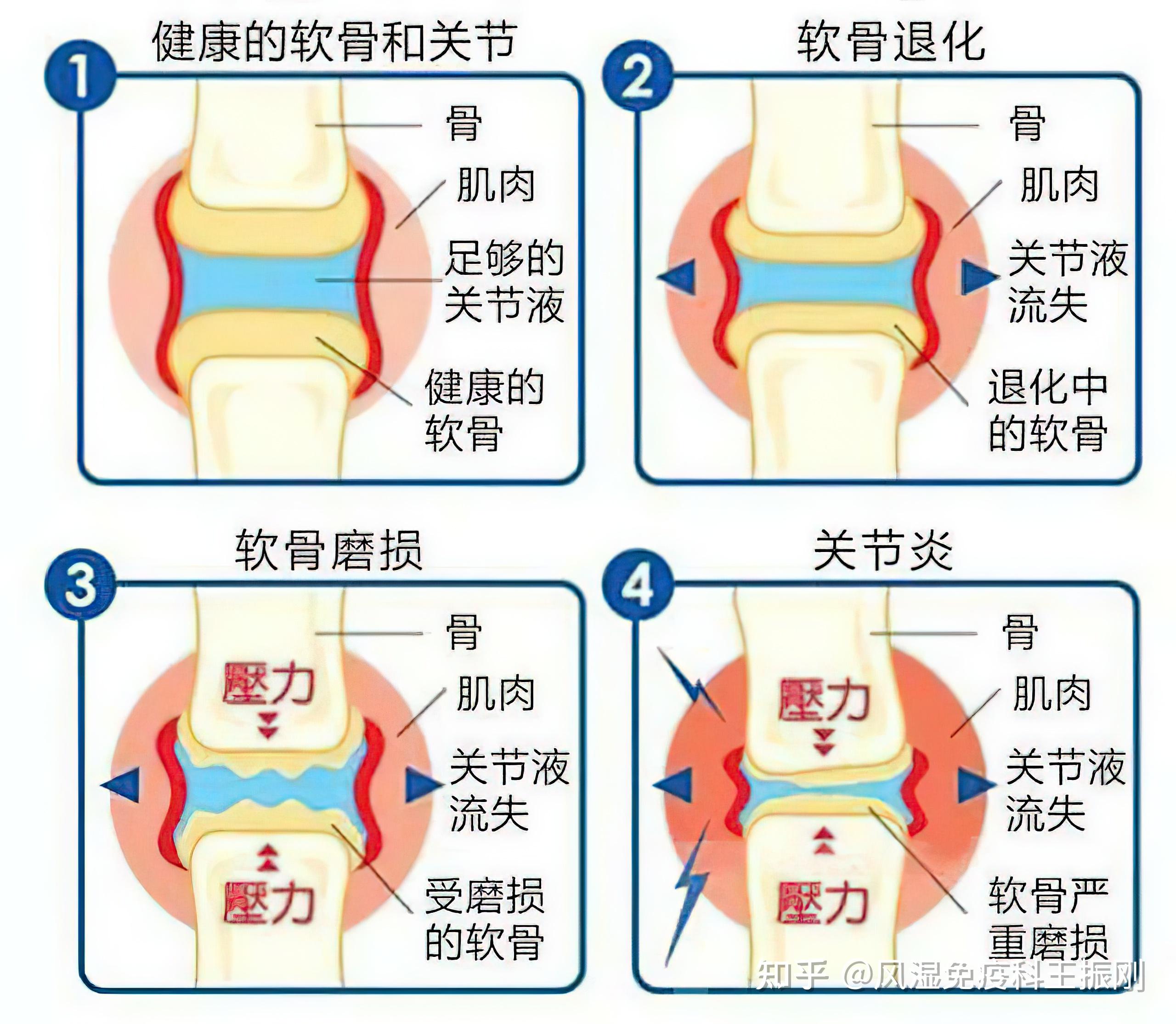 调整坐,站,行,跑,睡五种姿势,预防颈,腰,膝关节退变