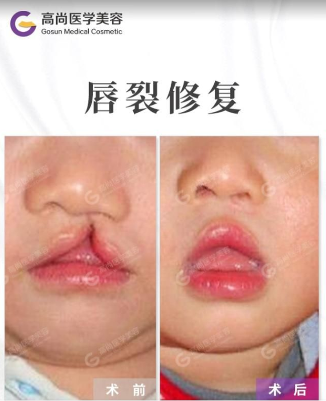 兔唇医院兔唇手术前后对比照片