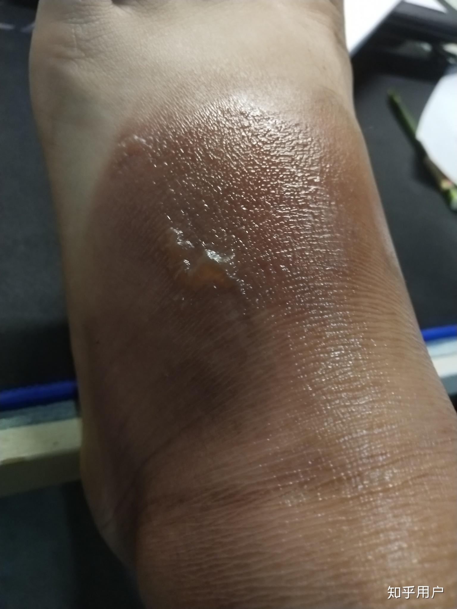 脚被开水烫了怎么办? - 知乎