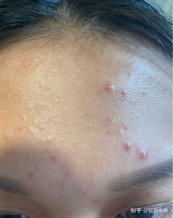 我额头长那种红肿硬的痘痘半个多月也没消也不冒白头我怎么才能让痘痘