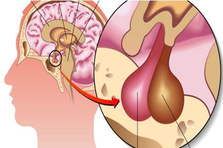 【就診指導】泌乳素垂體瘤應該怎麼治療?