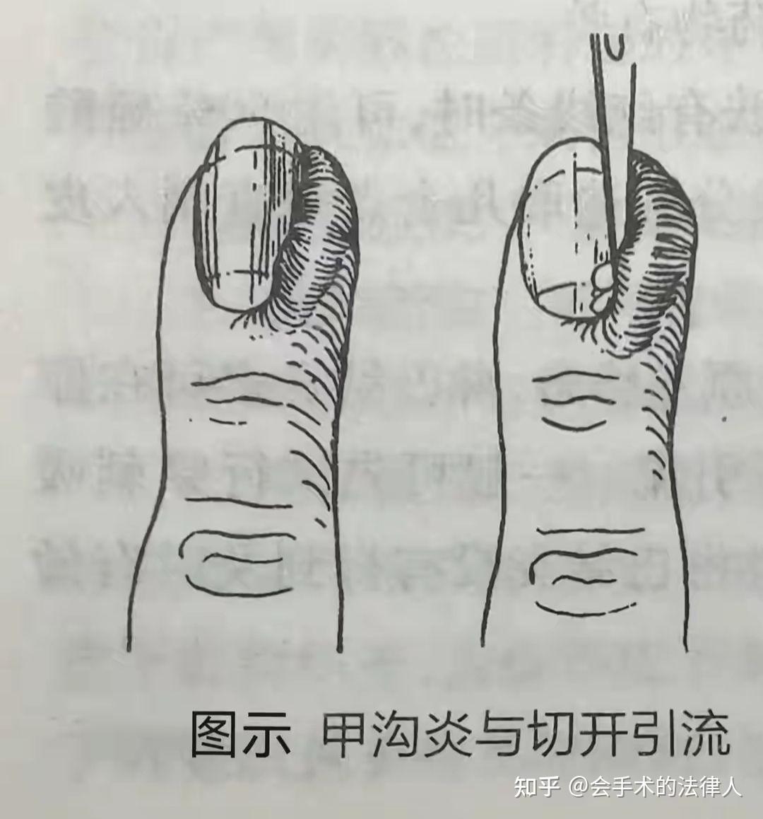 谈谈甲沟炎的治疗