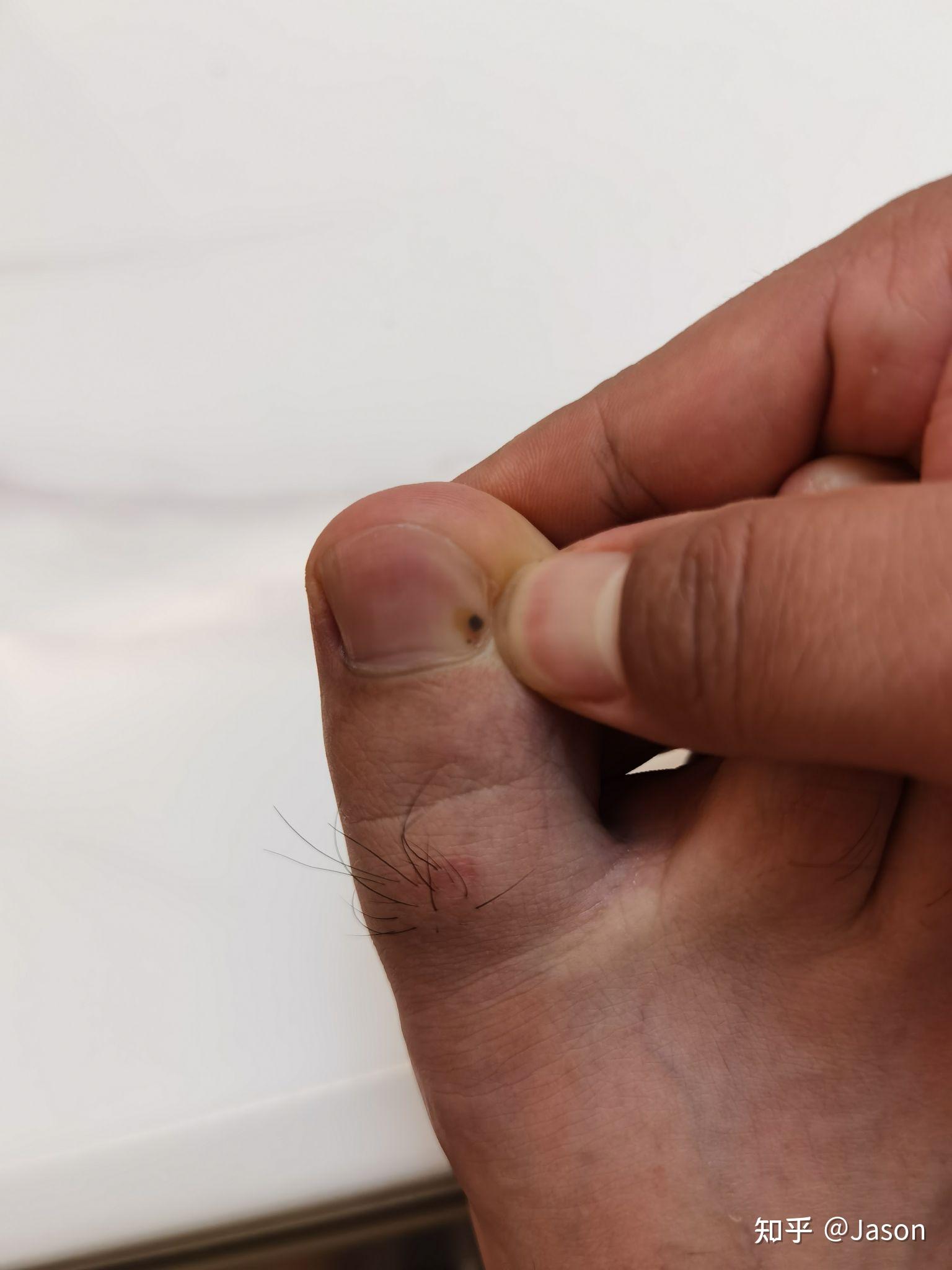 脚大拇指有黑块是癌图片