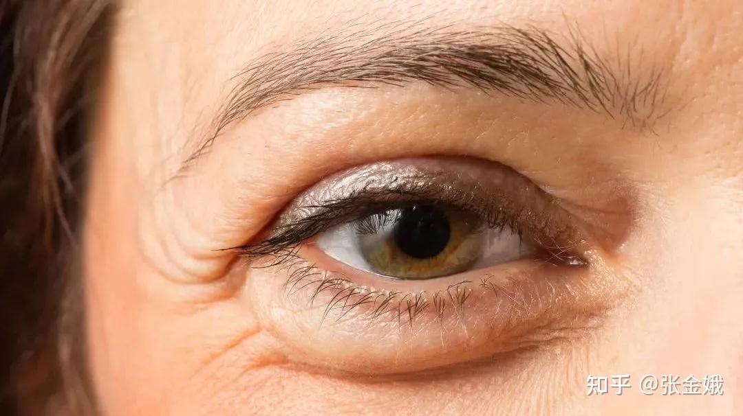 眼周太多皱纹有比较好的办法祛除吗? - 知乎
