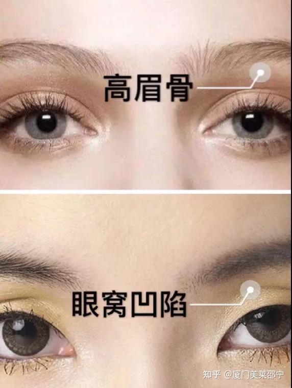 厦门双眼皮怎么知道自己是否适合做宽双眼皮