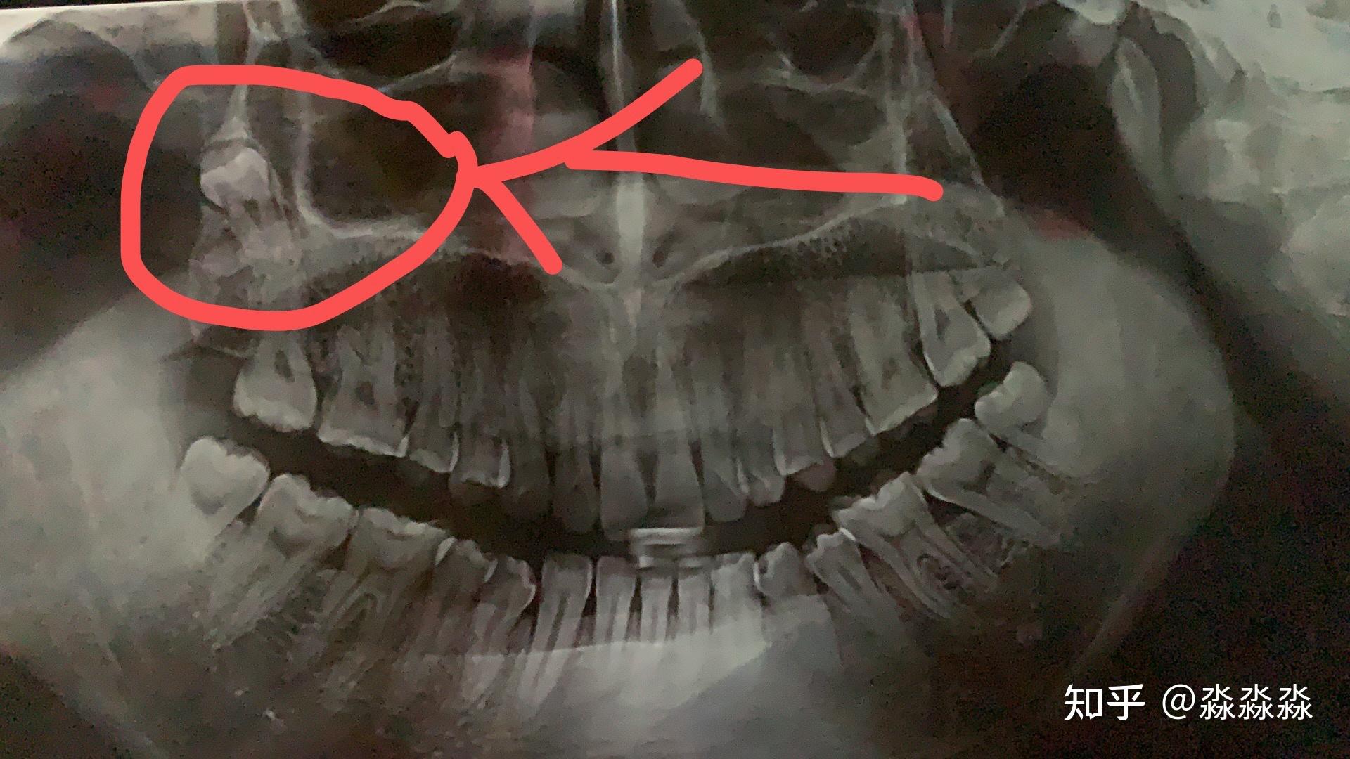 倒着长的智齿是什么样的? - 知乎