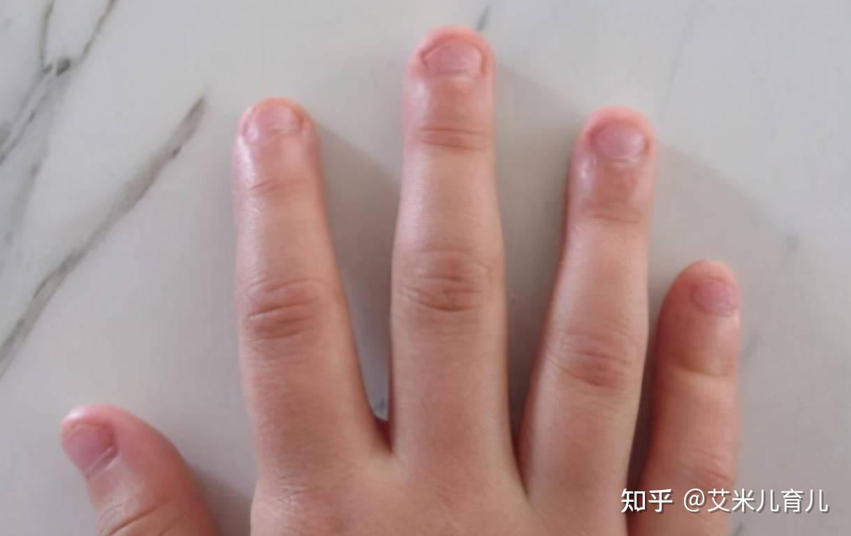 手指甲有黑色的竖线，是怎么回事（有图）_百度知道