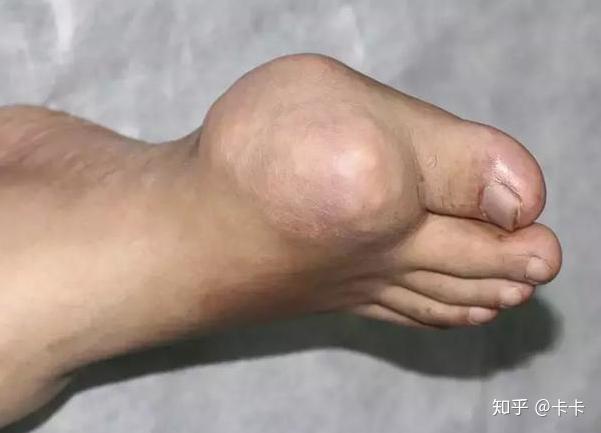 43岁出租司机尿酸高到渗人医生骨头被痛风石吃了要命就截肢