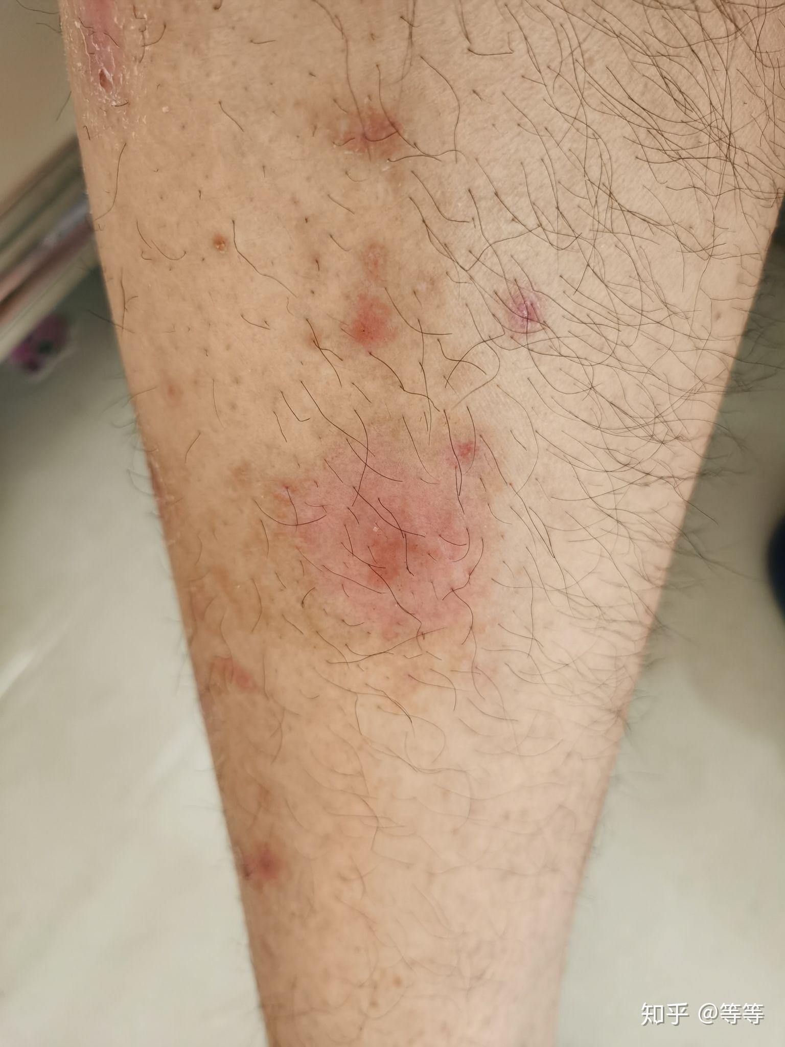 两年牛皮癣银屑病的经历