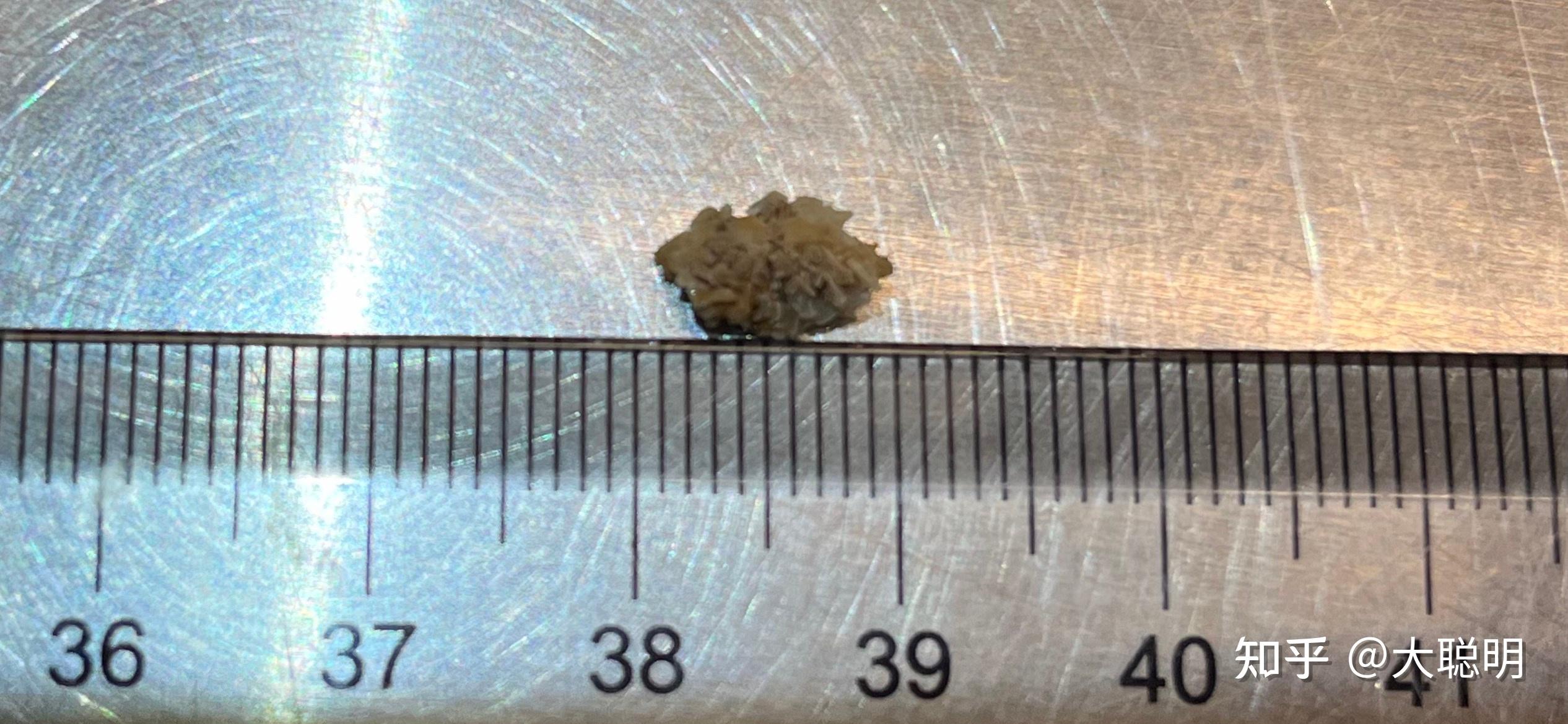 8mm结石能自己排出吗?