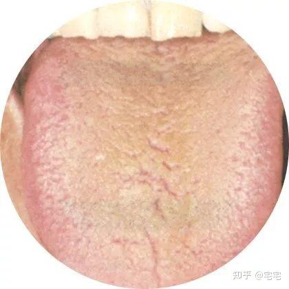 史上最全!高清舌诊图谱,看舌头知健康,人手一份! - 知乎