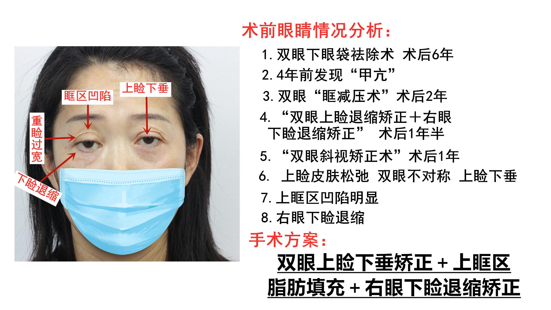 女士曾患甲相关疾病右眼上睑退缩矫正
