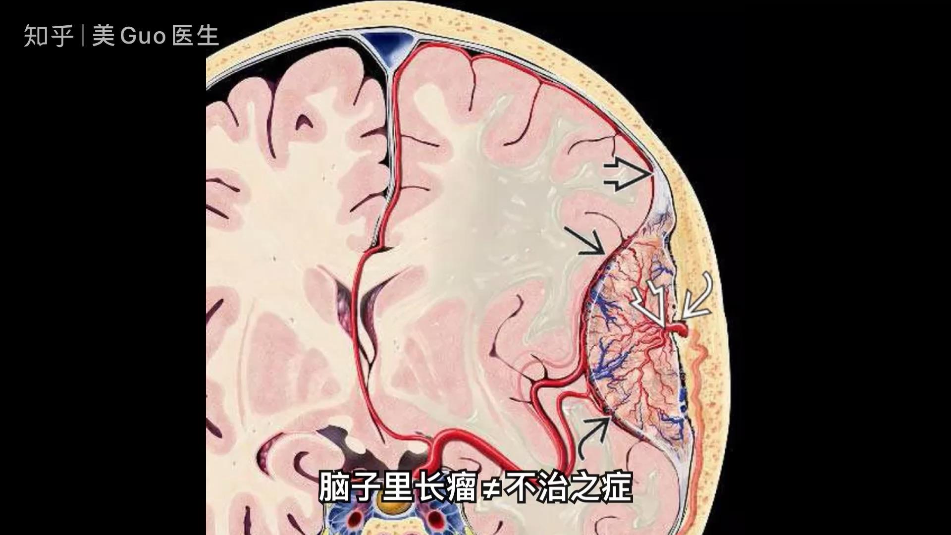 脑子积水了会真的变傻