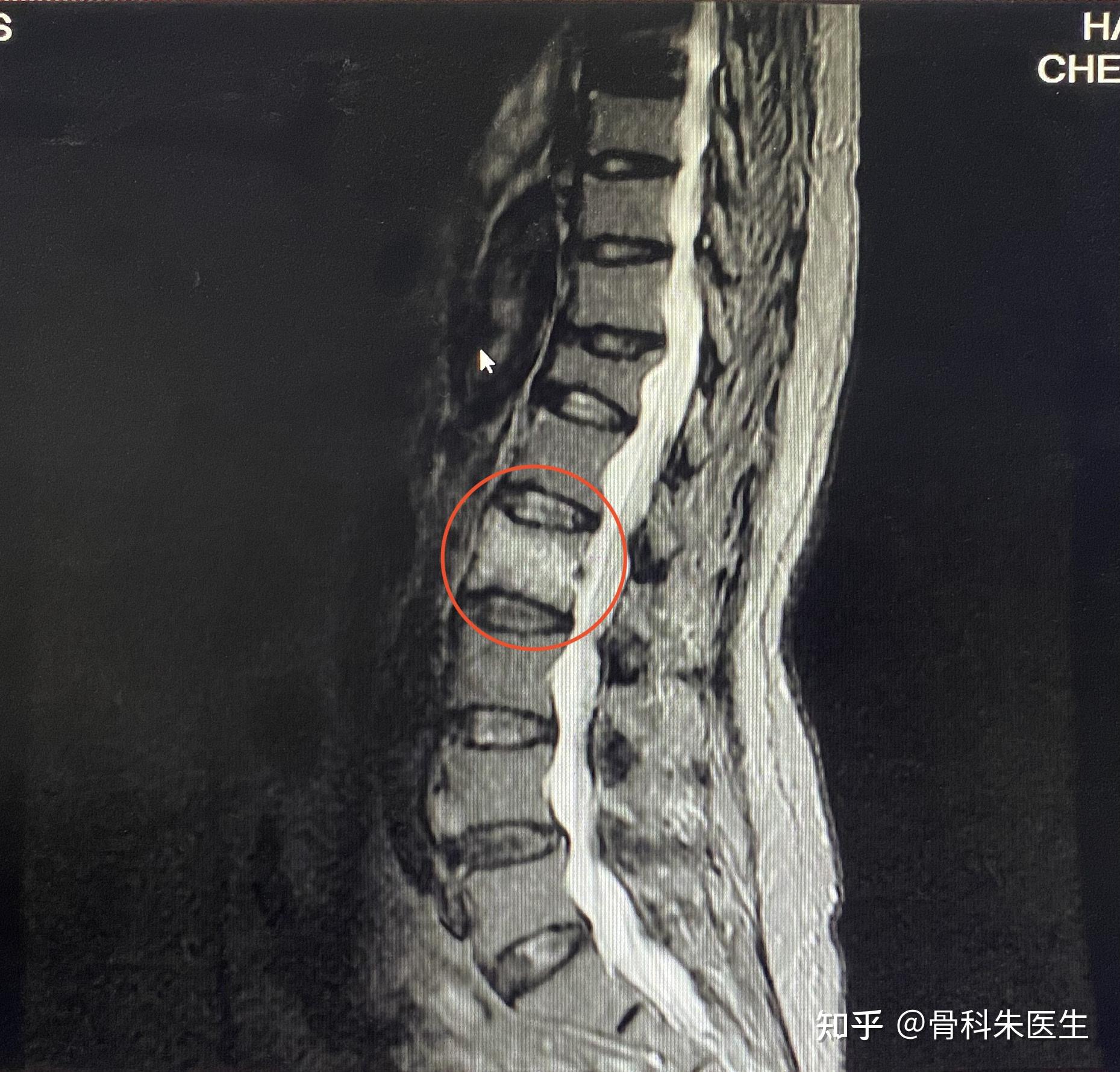 患者故事 又一例只有65岁的重度骨质疏松