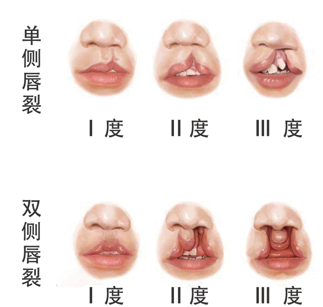 唇腭裂的临床分类 - 知乎