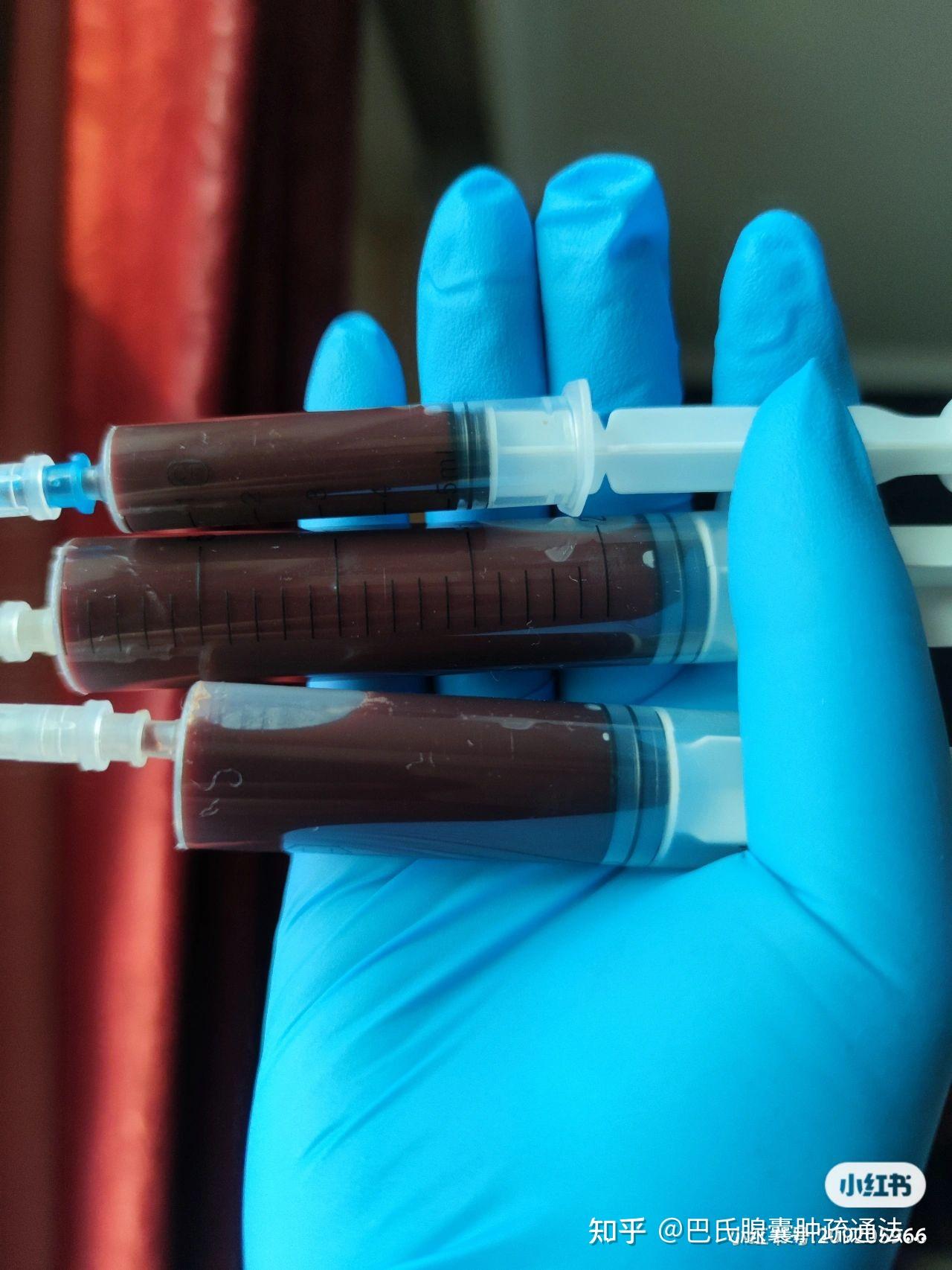 巴氏腺囊肿前庭大腺囊肿