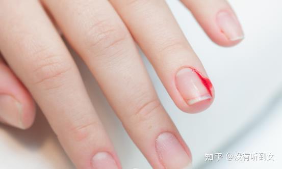 倒刺虽小处理不好会出大问题 预防倒刺有妙招 - 知乎