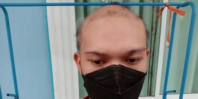 19岁男生打完新冠疫苗后不停掉头发,他称接受不了自己现在的样子!