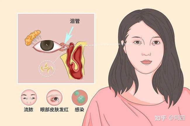 西宁爱尔:泪道堵塞了怎么办?我告诉你几个诊治方法 - 知乎