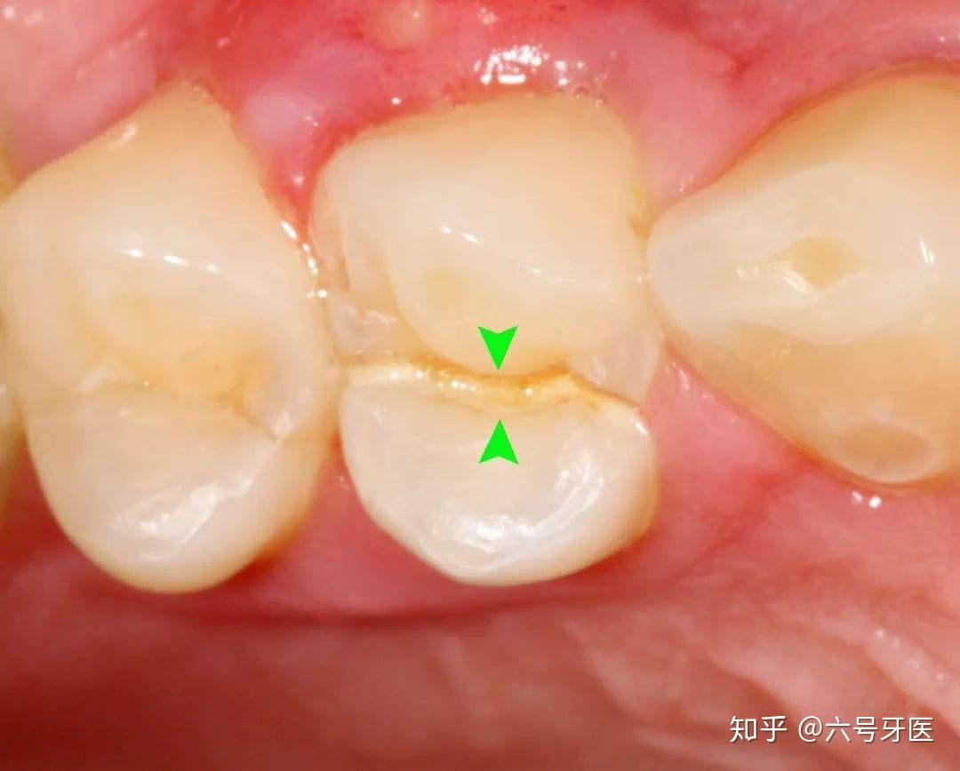 牙齒咬起來有點痛的---牙齒裂了 - 案例介紹 - 美容牙科張凱榮醫師