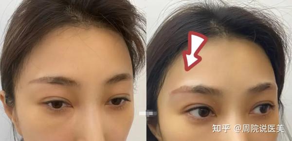 9成小姐姐都想了解的整形问题:珊瑚骨填充眉弓多久恢复? - 知乎