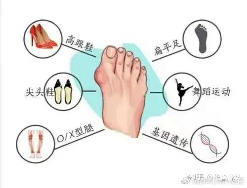 【健康科普】拇外翻？经常脚疼的人该注意了 - 知乎