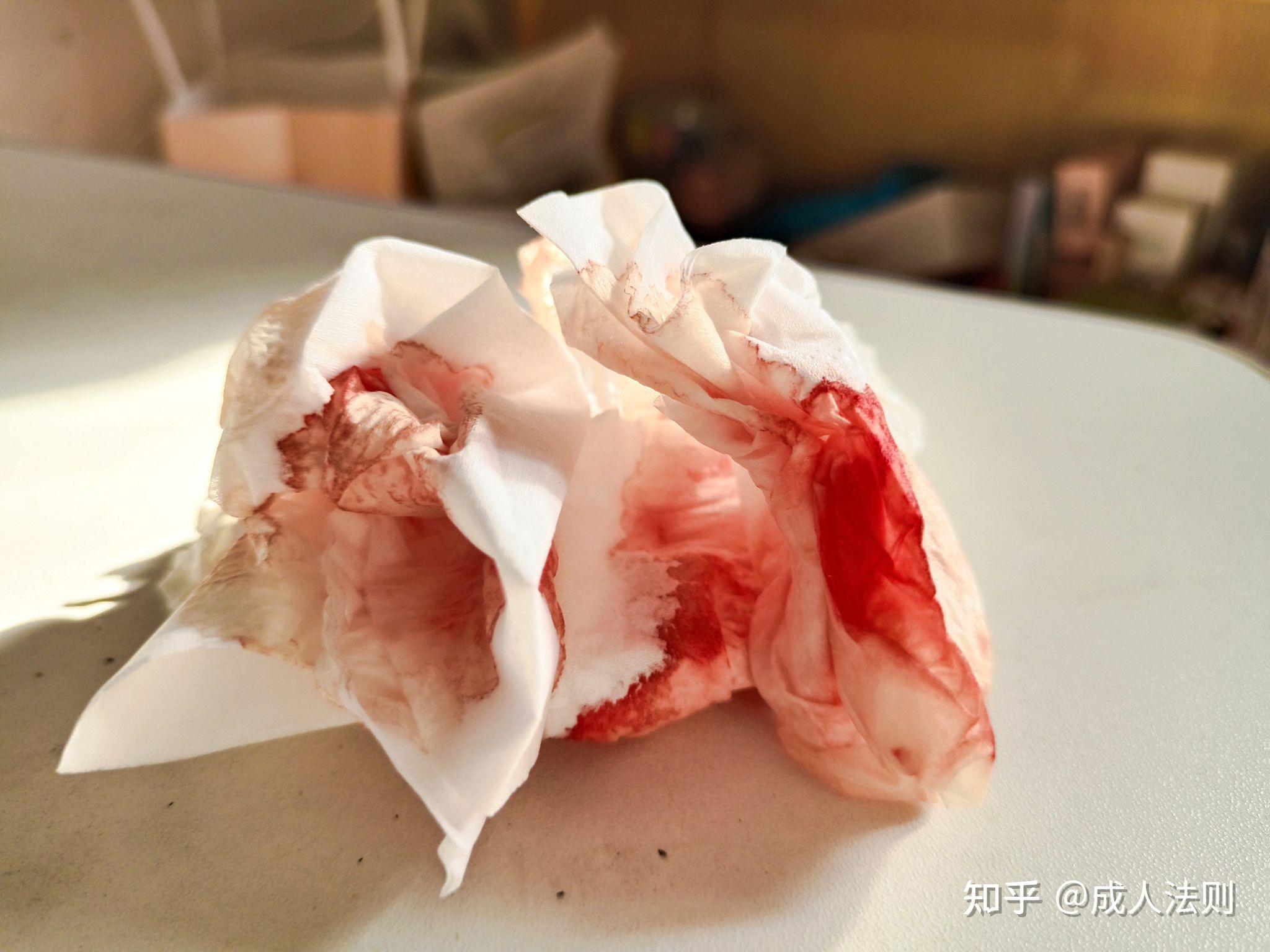 一个人去医院补牙拔智齿需要注意什么