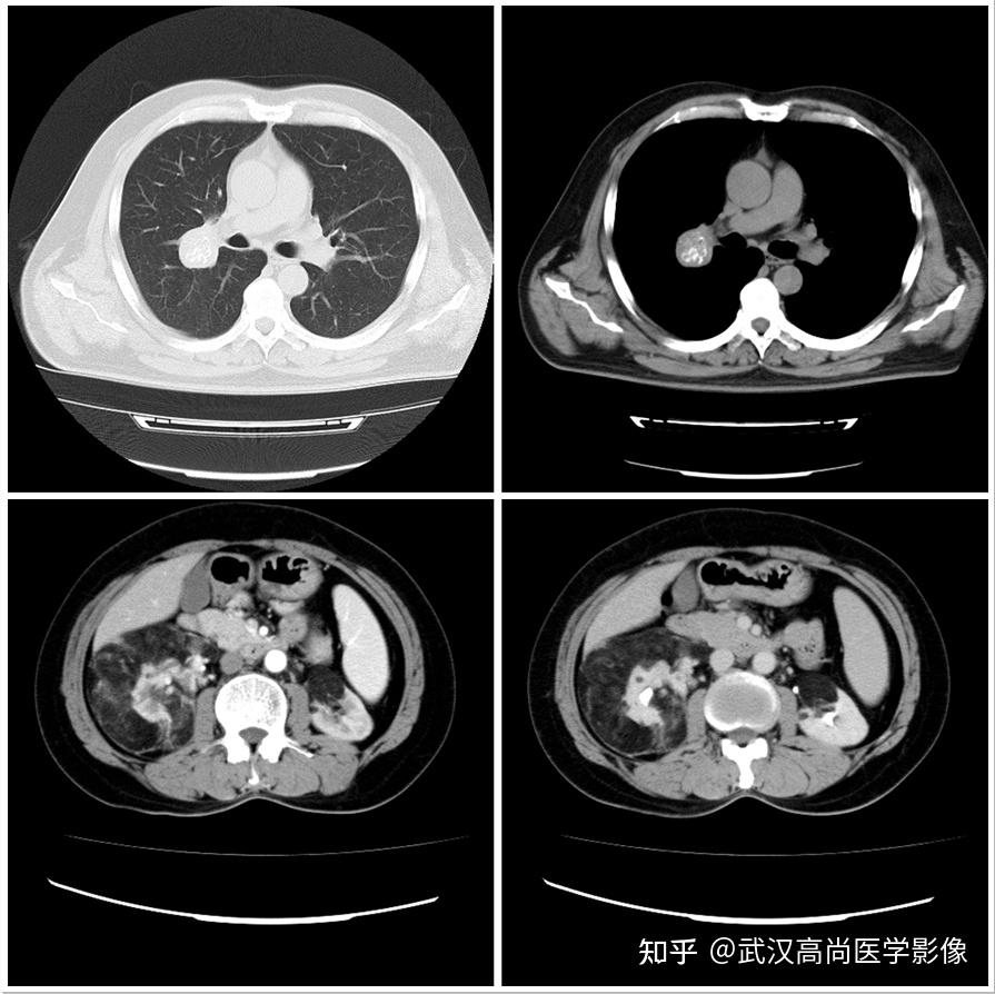 盘点一下那些叫“瘤”却不是肿瘤的病变「武汉高尚医学影像」 - 知乎