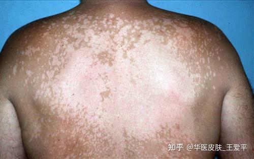 花斑癣有哪些危害,有哪些表现,北京花斑癣医院 - 知乎