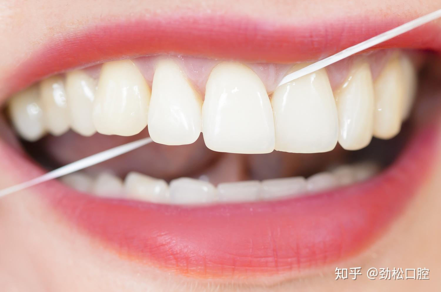 1个牙缝有问题，2颗牙齿被牵连——邻面龋修补 - 知乎