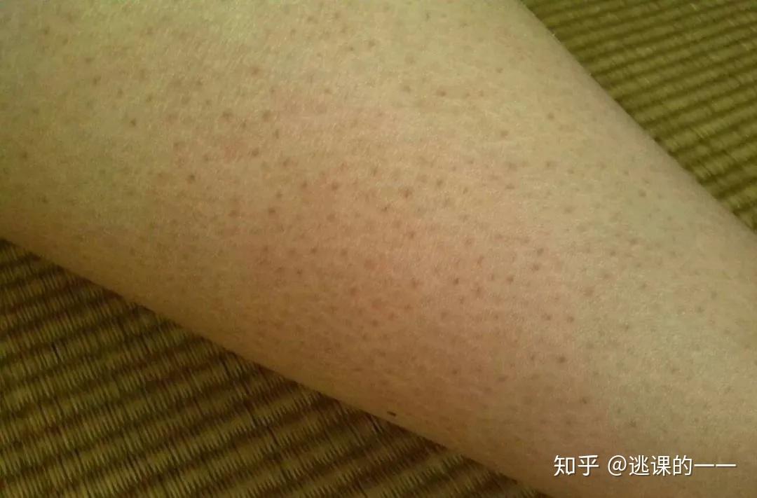 鸡皮肤动手术容易留疤痕吗(鸡皮肤动手术容易留疤痕吗怎么办)