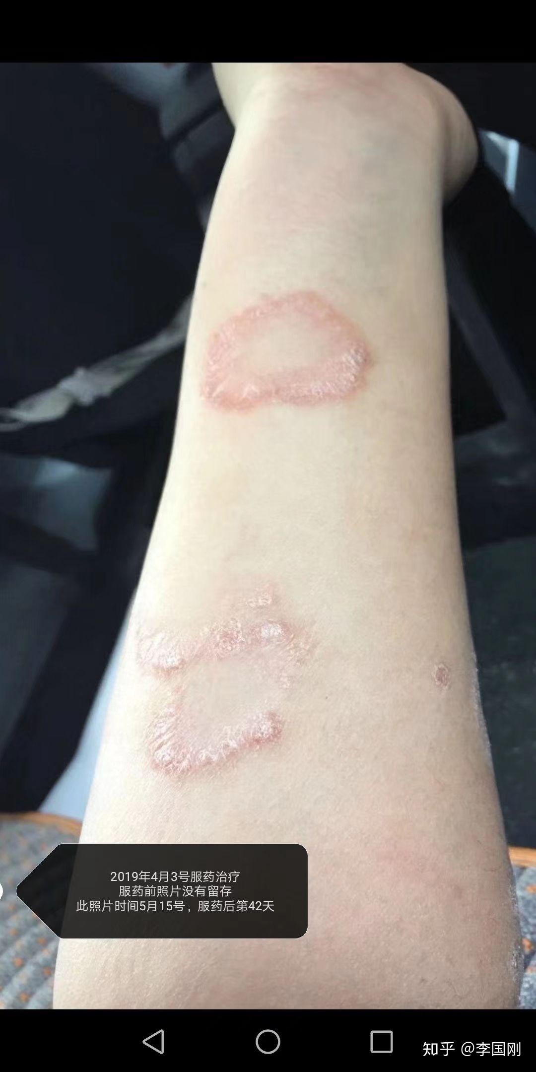 手背块状银屑病治疗效果(山东.烟台) - 知乎