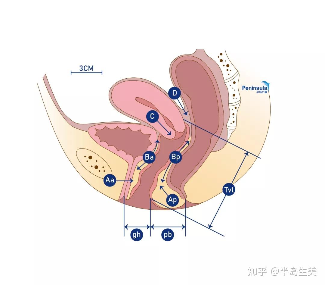 6个点3条线,一文搞懂pop-q分期