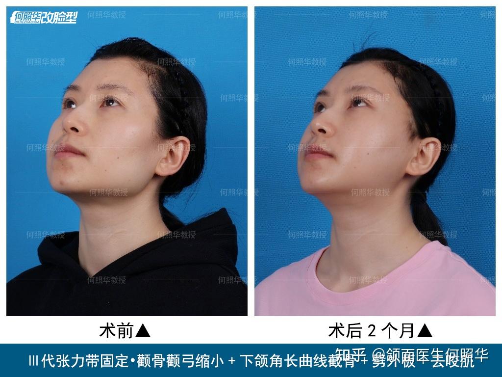 三甲医院下颌角截骨失败_下颌角截骨手术视频_下颌角截骨整形医院