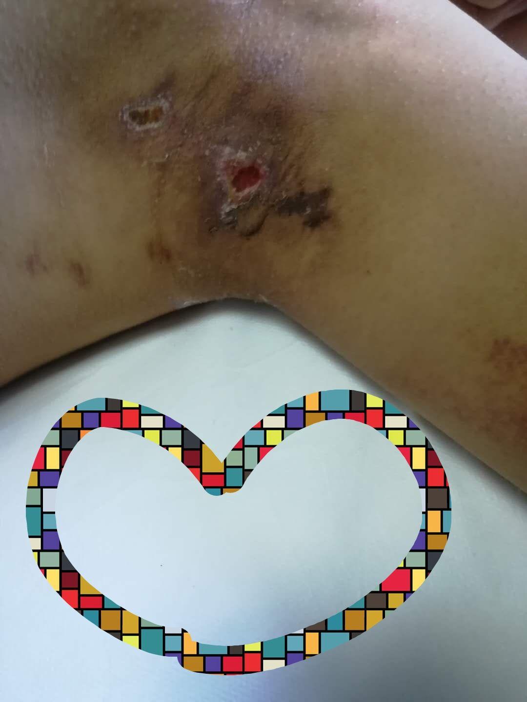 请问有没有做过狐臭手术的朋友有没有后遗症请给个回答让我做个参考