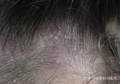 头皮脂溢性皮炎怎么办?非常值得看的一篇文章! - 知乎