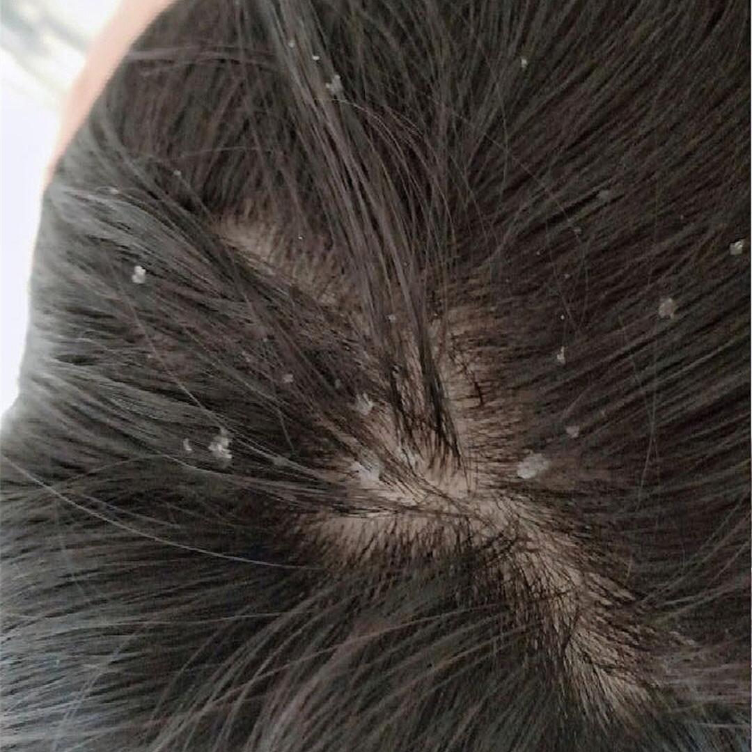 有没有一款去屑止痒的洗发水? - 知乎