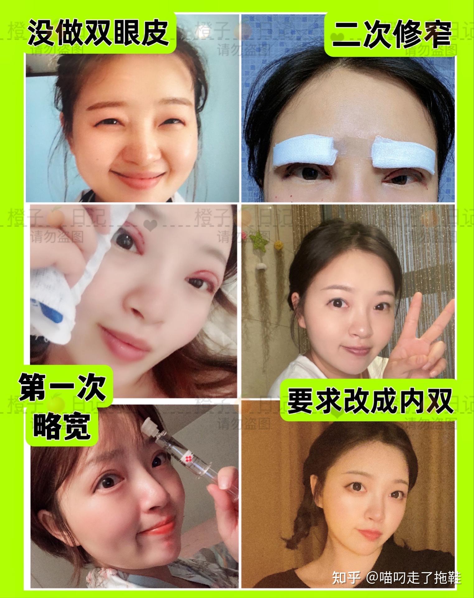 2次双眼皮,最终又改成内双 - 知乎