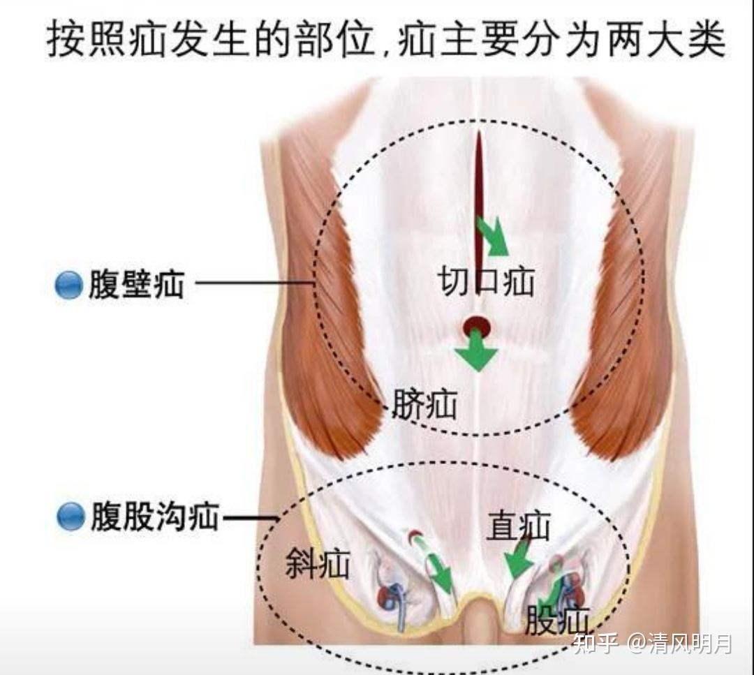 疝气的症状小儿图片