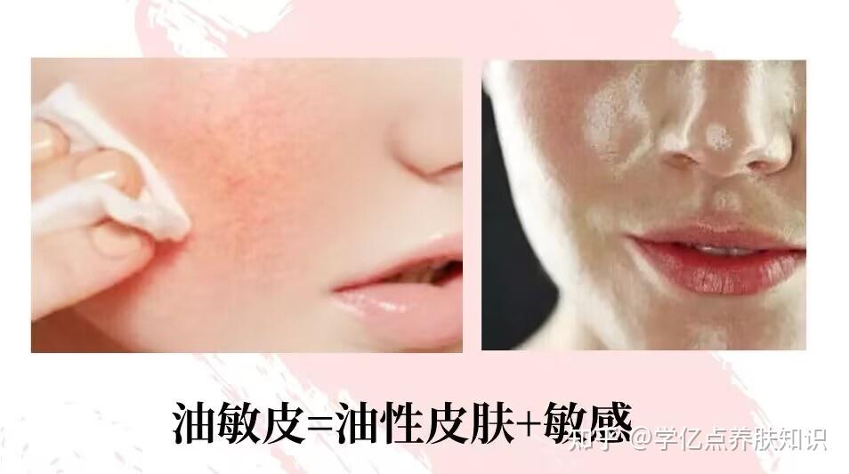 外油内干？干敏皮一次讲清楚！ - 知乎