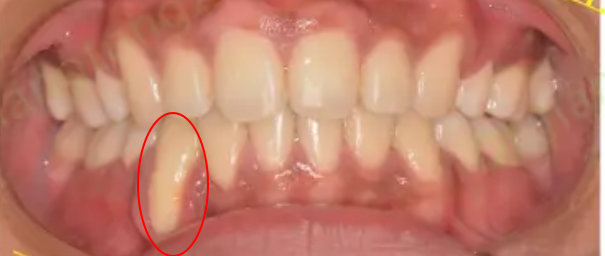 能否科普一下"骨开窗"?
