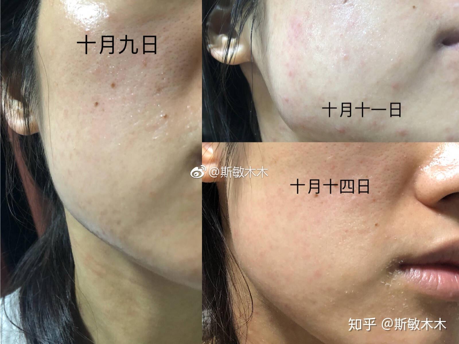 维a酸乳膏的使用记录