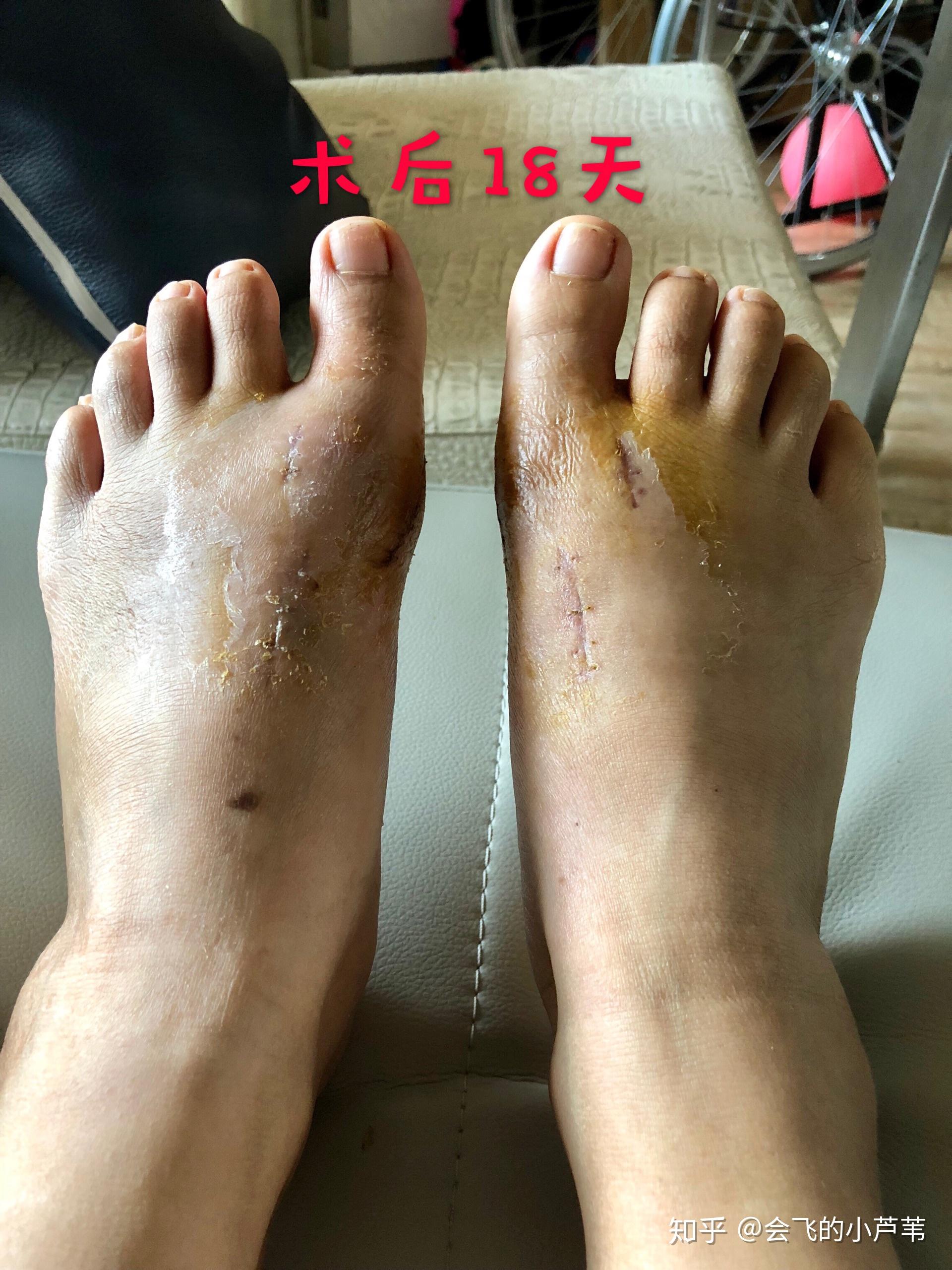 北京丰台广济医院科普：大脚骨会对身体有什么影响? - 知乎