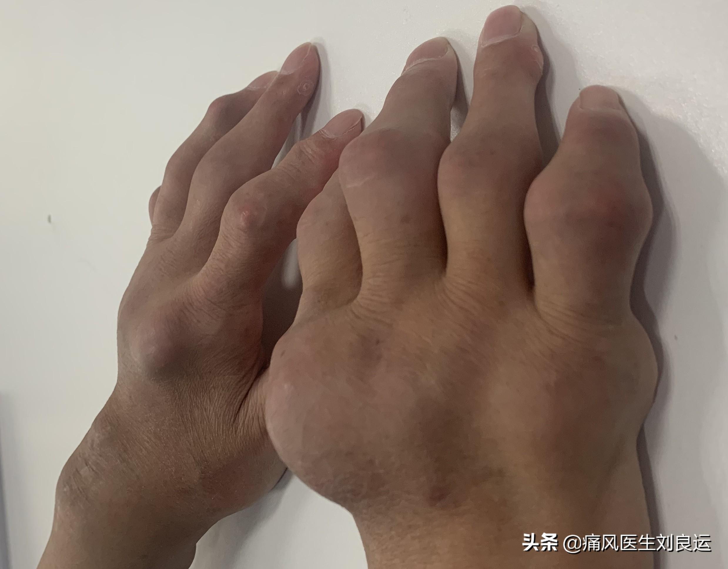 痛风能被根治吗?医生辟谣:做到这六个方面可以临床治愈但无法根治