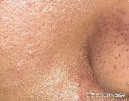 因为男性的皮脂腺和汗腺都比较大,角质层较厚,毛孔粗大,因此油脂分泌